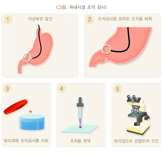 위내시경 검사 절차 설명 이미지 2