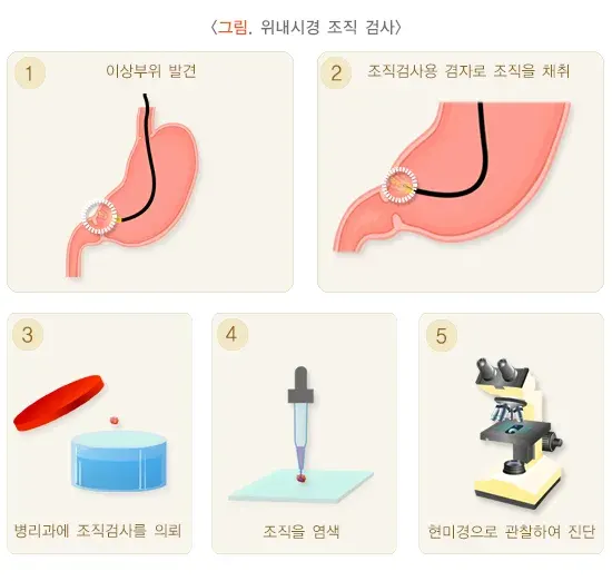 위내시경 검사 절차 설명 이미지 2