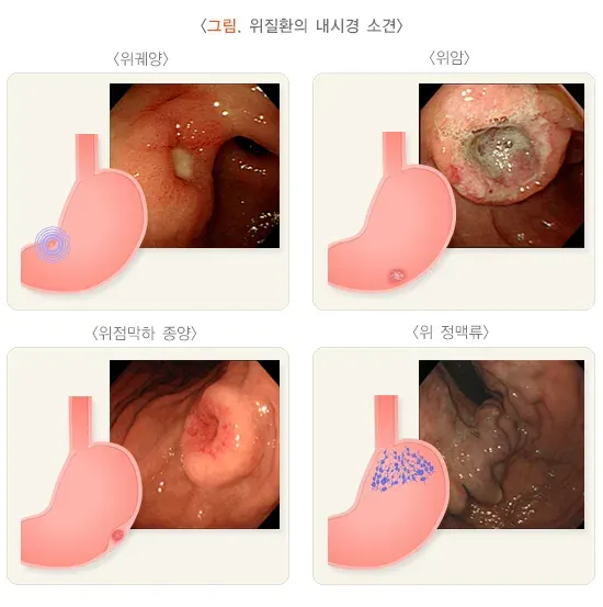 위내시경 검사 결과 해석 설명 이미지 2