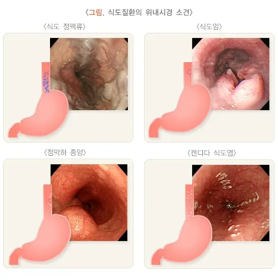 위내시경 검사 결과 해석 설명 이미지 1