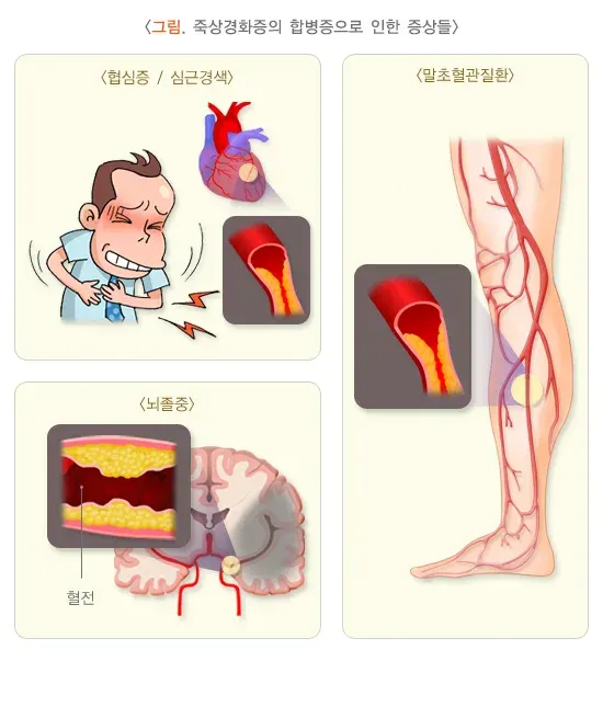 죽상경화증 증상 설명 이미지 1