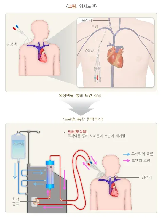 혈액투석 치료 방법 설명 이미지 2