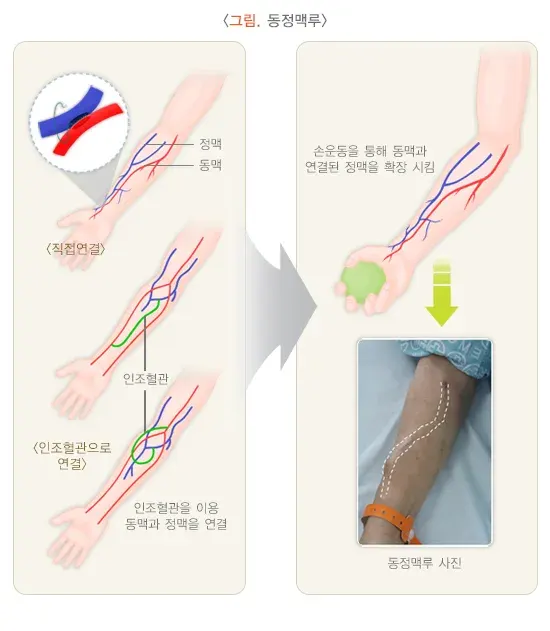 혈액투석 치료 방법 설명 이미지 1