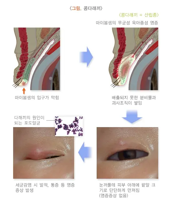 다래끼와 콩다래끼 종류 설명 이미지 2