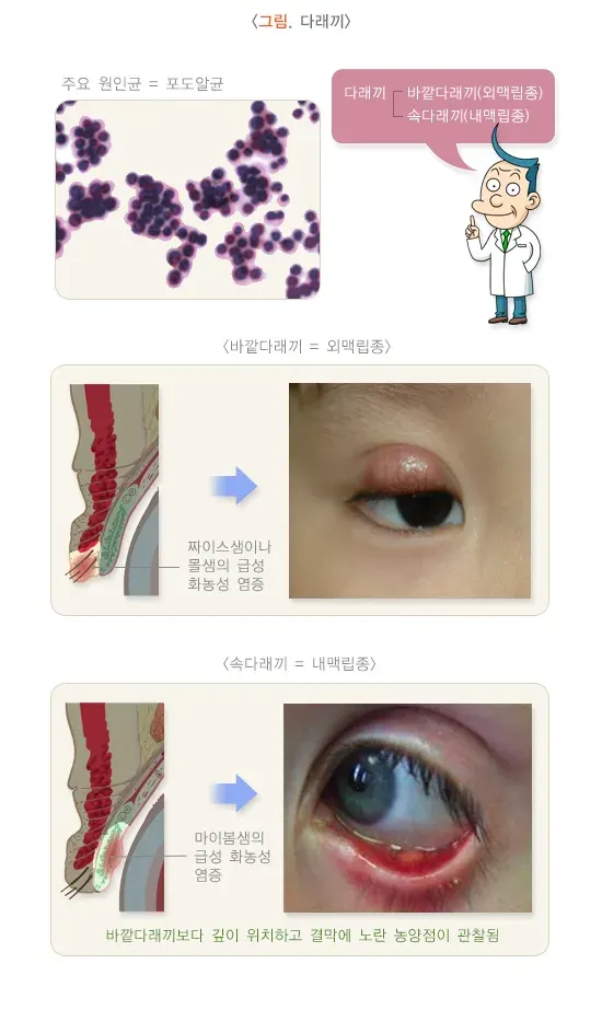 다래끼와 콩다래끼 종류 설명 이미지 1