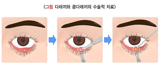 다래끼와 콩다래끼 치료 설명 이미지 1