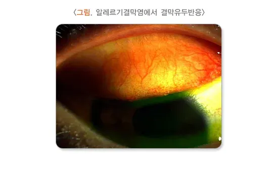 알레르기결막염 진단 및 검사 설명 이미지 1
