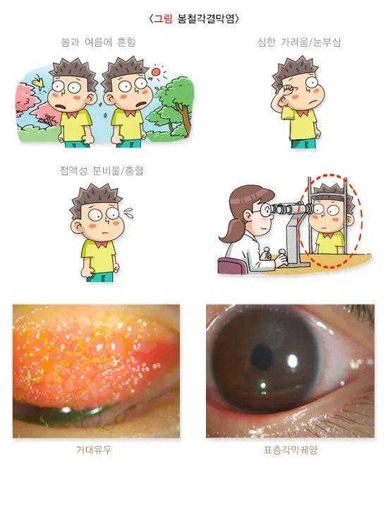 알레르기결막염 진단 및 검사 설명 이미지 2