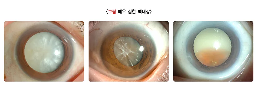 백내장 증상 설명 이미지 6