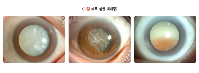 백내장 증상 설명 이미지 6