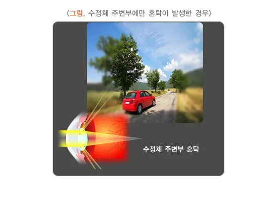 백내장 증상 설명 이미지 1