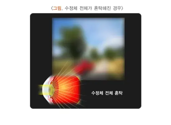 백내장 증상 설명 이미지 3