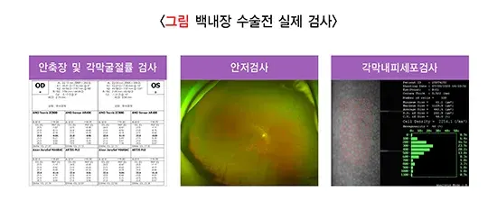 백내장 진단 및 검사 설명 이미지 2