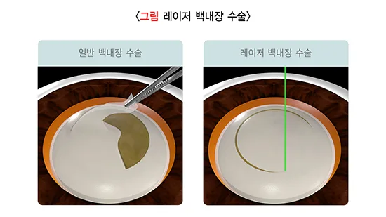 백내장 치료 설명 이미지 3