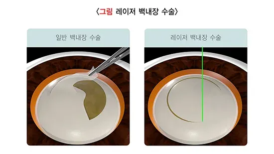 백내장 치료 설명 이미지 3