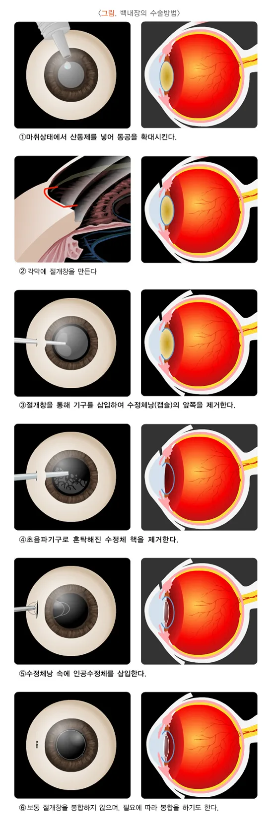 백내장 치료 설명 이미지 2