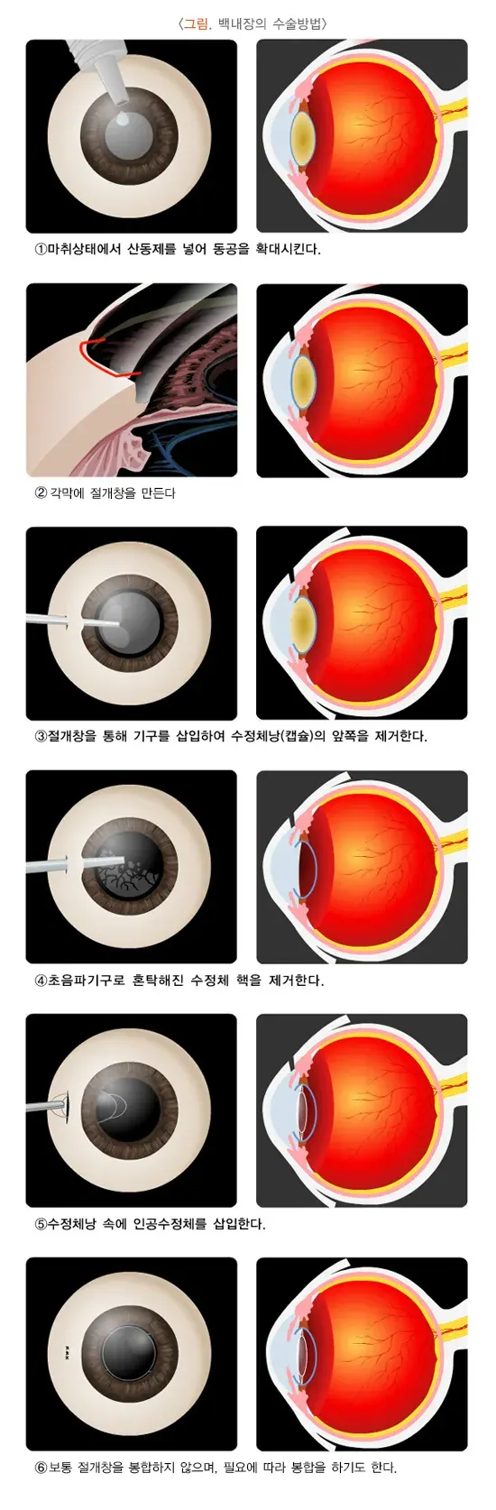 백내장 치료 설명 이미지 2