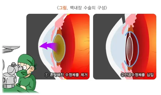 백내장 치료 설명 이미지 1