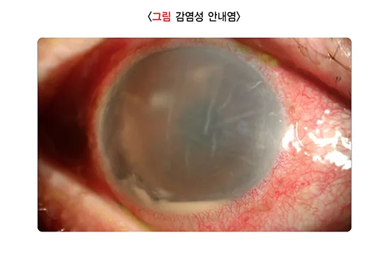 백내장 합병증 설명 이미지 1