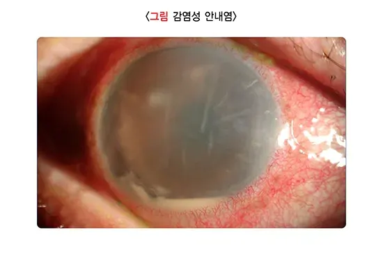 백내장 합병증 설명 이미지 1