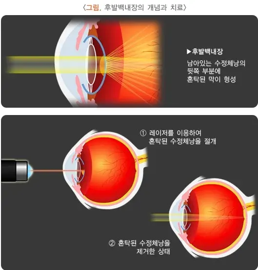 백내장 합병증 설명 이미지 2