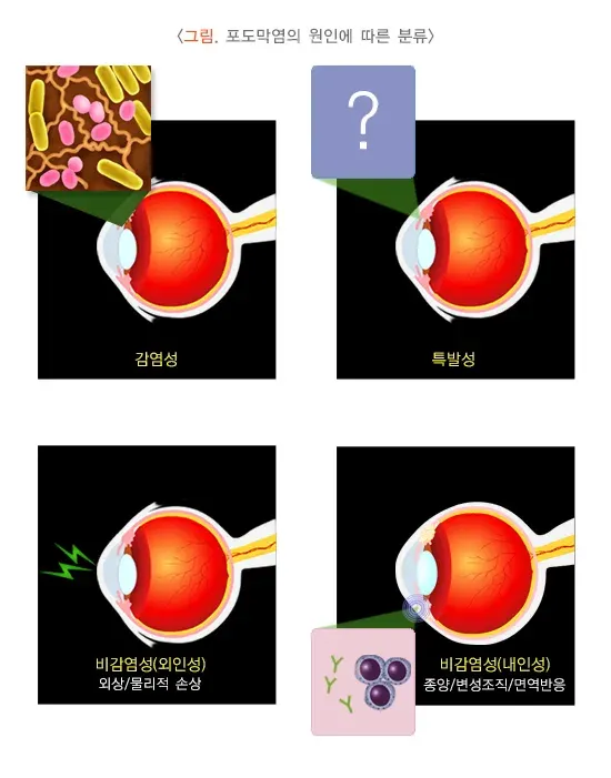 포도막염 종류 설명 이미지 1