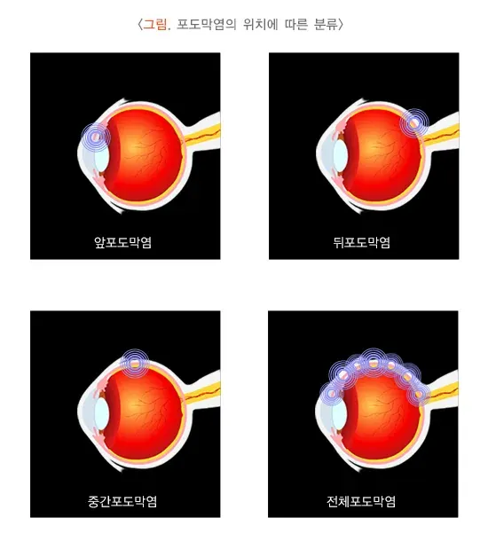 포도막염 종류 설명 이미지 2