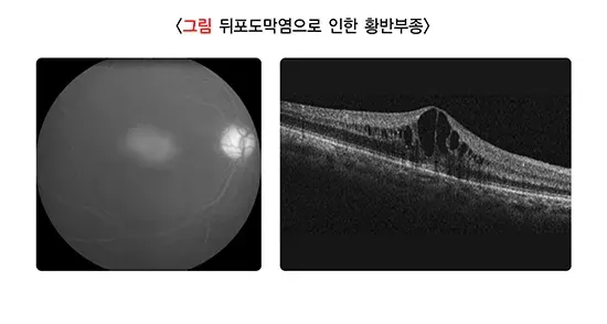 포도막염 종류 설명 이미지 6