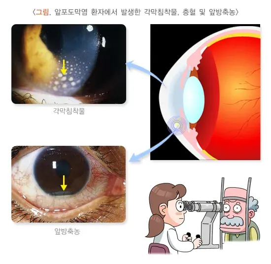포도막염 종류 설명 이미지 3