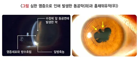 포도막염 종류 설명 이미지 4