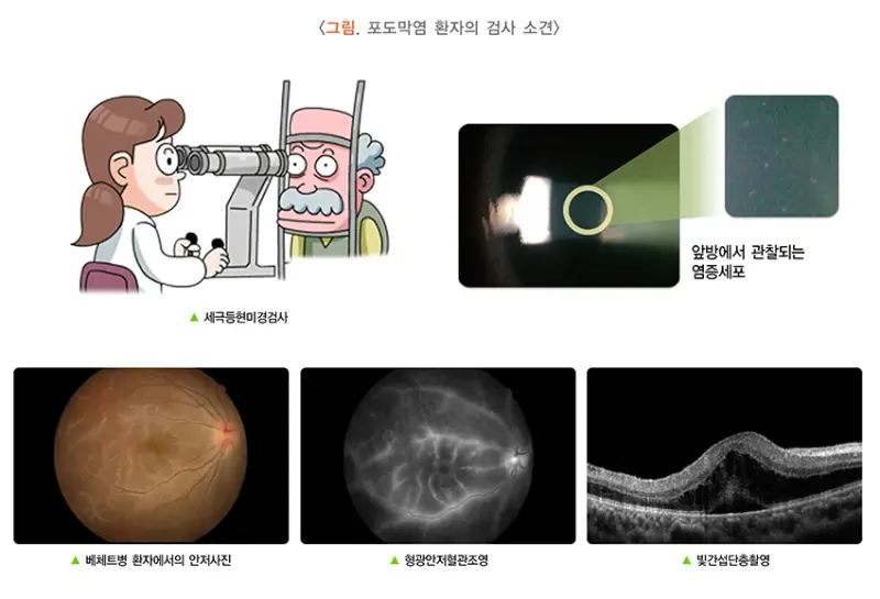 포도막염 진단 및 검사 설명 이미지 1