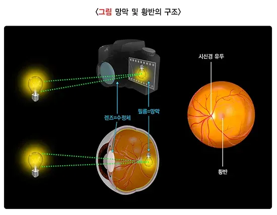 황반변성 정의 설명 이미지 1