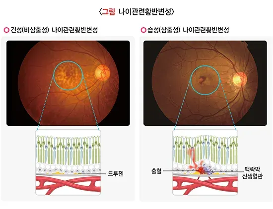황반변성 종류 설명 이미지 1