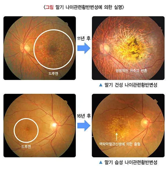 황반변성 역학 및 통계 설명 이미지 1
