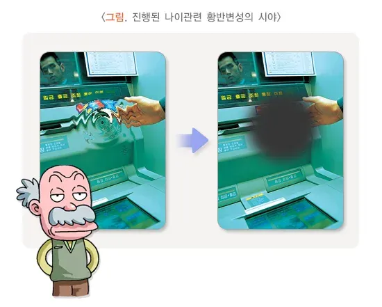 황반변성 증상 설명 이미지 1