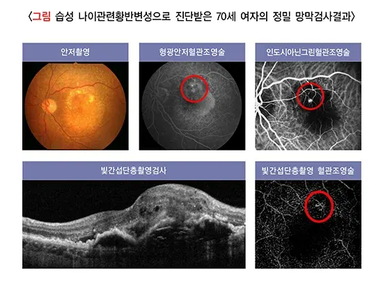 황반변성 진단 및 검사 설명 이미지 2