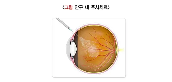 황반변성 치료 설명 이미지 2