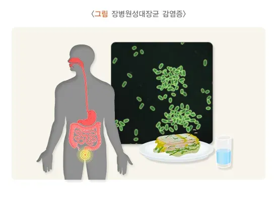 급성 세균성 장염 증상 설명 이미지 7