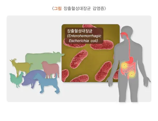 급성 세균성 장염 증상 설명 이미지 2