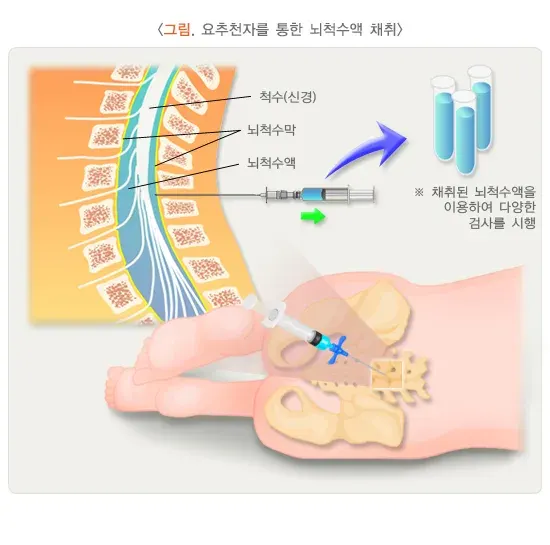 뇌수막염 진단 및 검사 설명 이미지 1