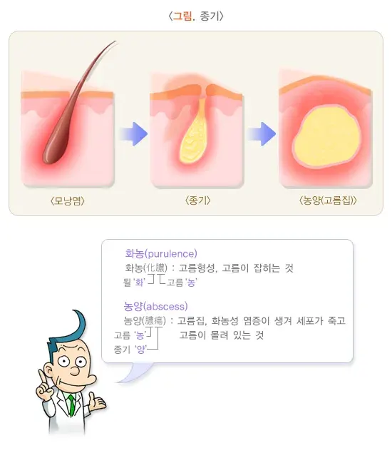 연조직염과 종기(종기) 정의 설명 이미지 1