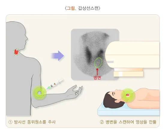 갑상선 결절 진단 및 검사 설명 이미지 2