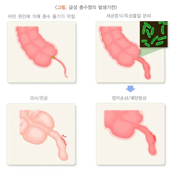 급성 충수염 원인 설명 이미지 1