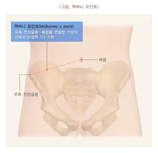 급성 충수염 진단 및 검사 설명 이미지 1