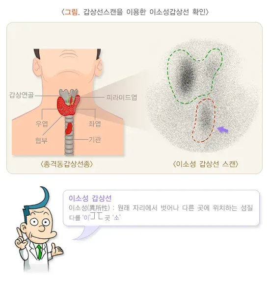 갑상선스캔 검사 결과 해석 설명 이미지 5