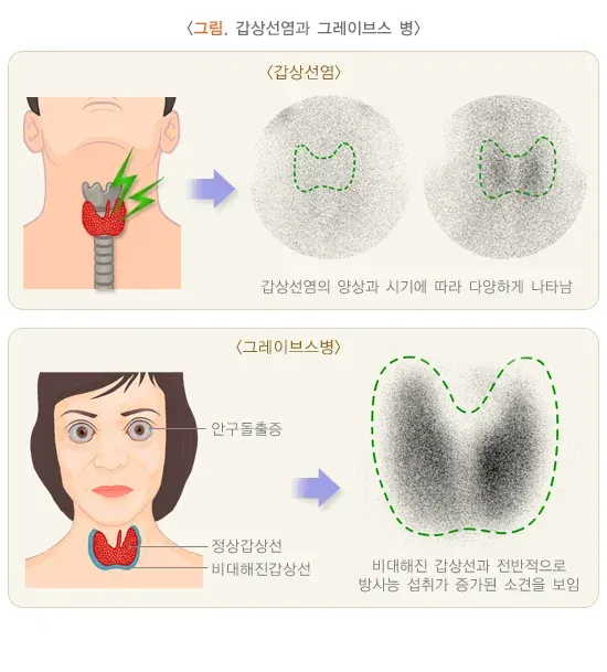 갑상선스캔 검사 결과 해석 설명 이미지 3