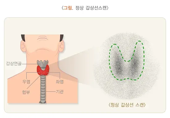 갑상선스캔 검사 결과 해석 설명 이미지 1