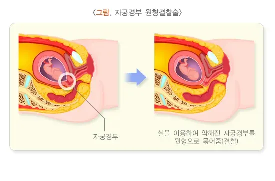 자연유산 원인 설명 이미지 5