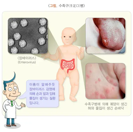 수족구병 정의 설명 이미지 1