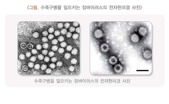 수족구병 원인 설명 이미지 1